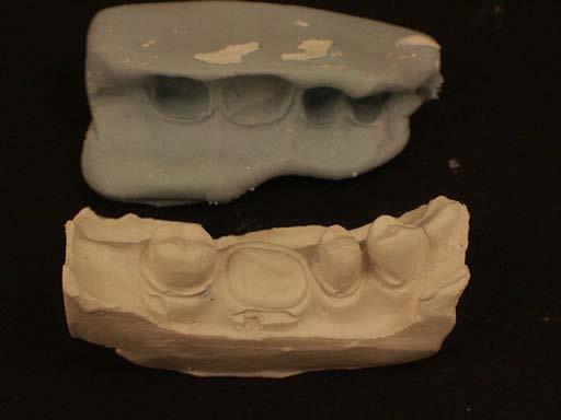 Impression captures FPD abutments as well as adjacent tooth 26.