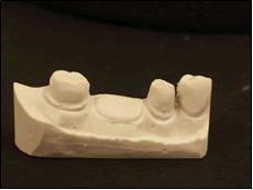 27. Prepare your cast for use on the dental surveyor.