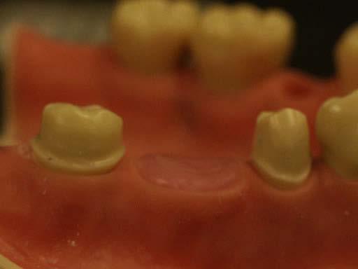 Fixed Partial Denture Restoration / Teeth # FPD-Full Gold Crown (FGC) / 29-x-31 Extensions: FPD-Porcelain Fused to Metal (PFM) / 9-x-11 FPD-Porcelain Fused to Metal (PFM) / 12-x-14 Ideal FPD