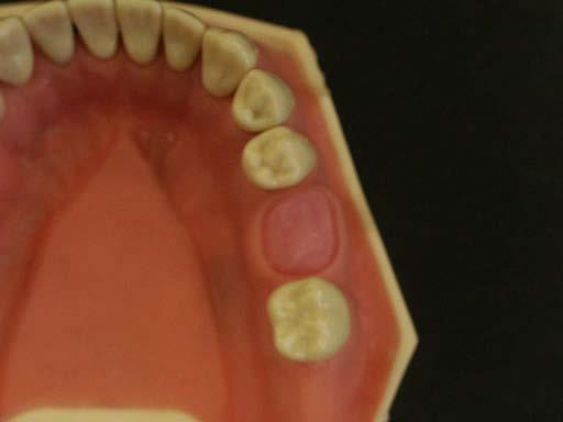 II. Set- up of the Articulated Teeth Since this is a simulated exercise, all tooth preparations should be done on a Frasaco Model mounted on a dental simulator. Fig. 3.