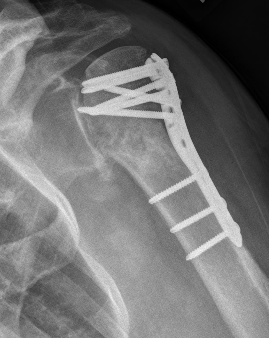 Complications of ORIF Proximal fixation failure Periprosthetic shaft fracture