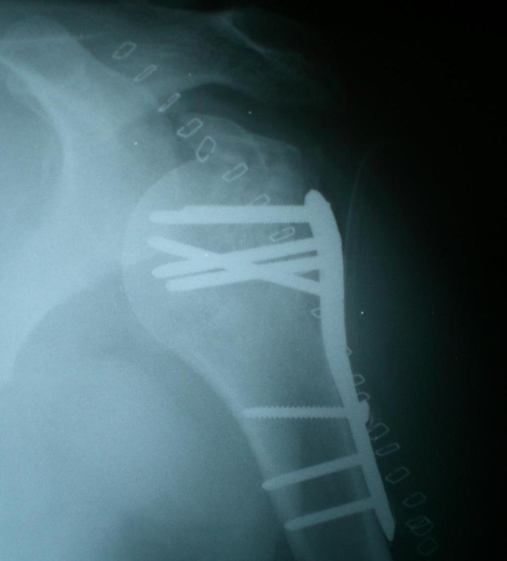 Complications of ORIF Proximal fixation failure Periprosthetic shaft fracture