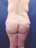 combined abdominoplasty and