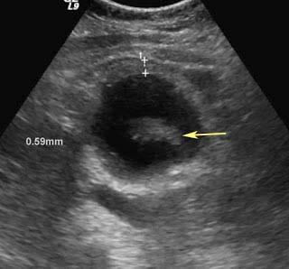 (Figure 1), with fluid supra- and sub-hepatically. Free air within the gallbladder wall was not seen. She was admitted to our hospital with the diagnosis of acute cholecystitis.