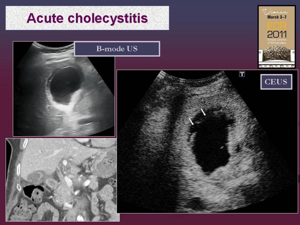 Fig. 3: Gangrenous cholecystitis.