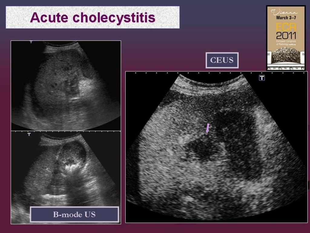 Fig. 4: Perichoclecystic abscess in acute cholecystitis.