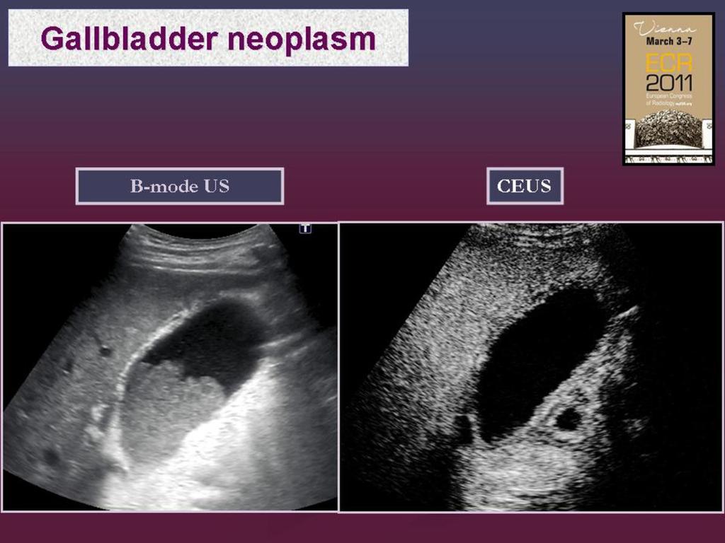 Fig. 5: Usefulness of contrast for differentiation between biliary sludge and