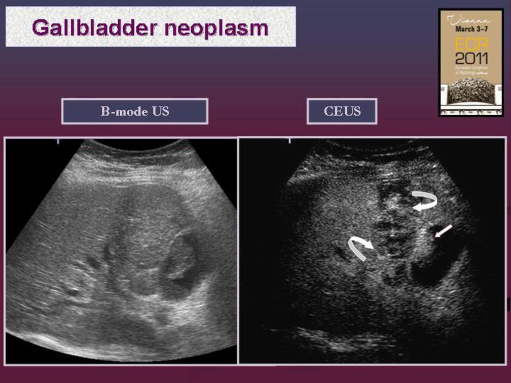 Fig. 10: CEUS: Gallbladder carcinoma.