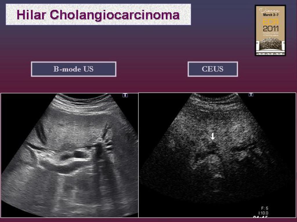Fig. 12: Intrahepatic cholangiocarcinoma (Klatskin tumor).