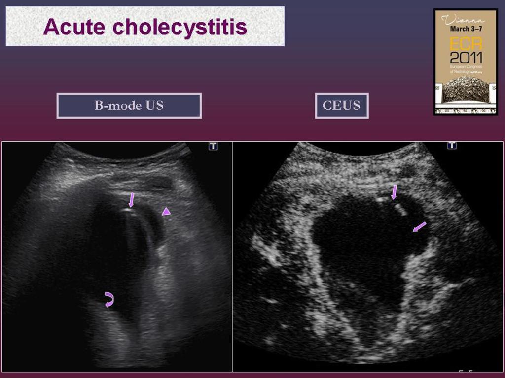 Fig. 2: Gangrenous cholecystitis.