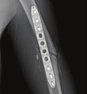 screws, and MotionLoc screws. Follow up x-rays were taken at 24 weeks post-op and show circumferential callus bridging across the fracture site.