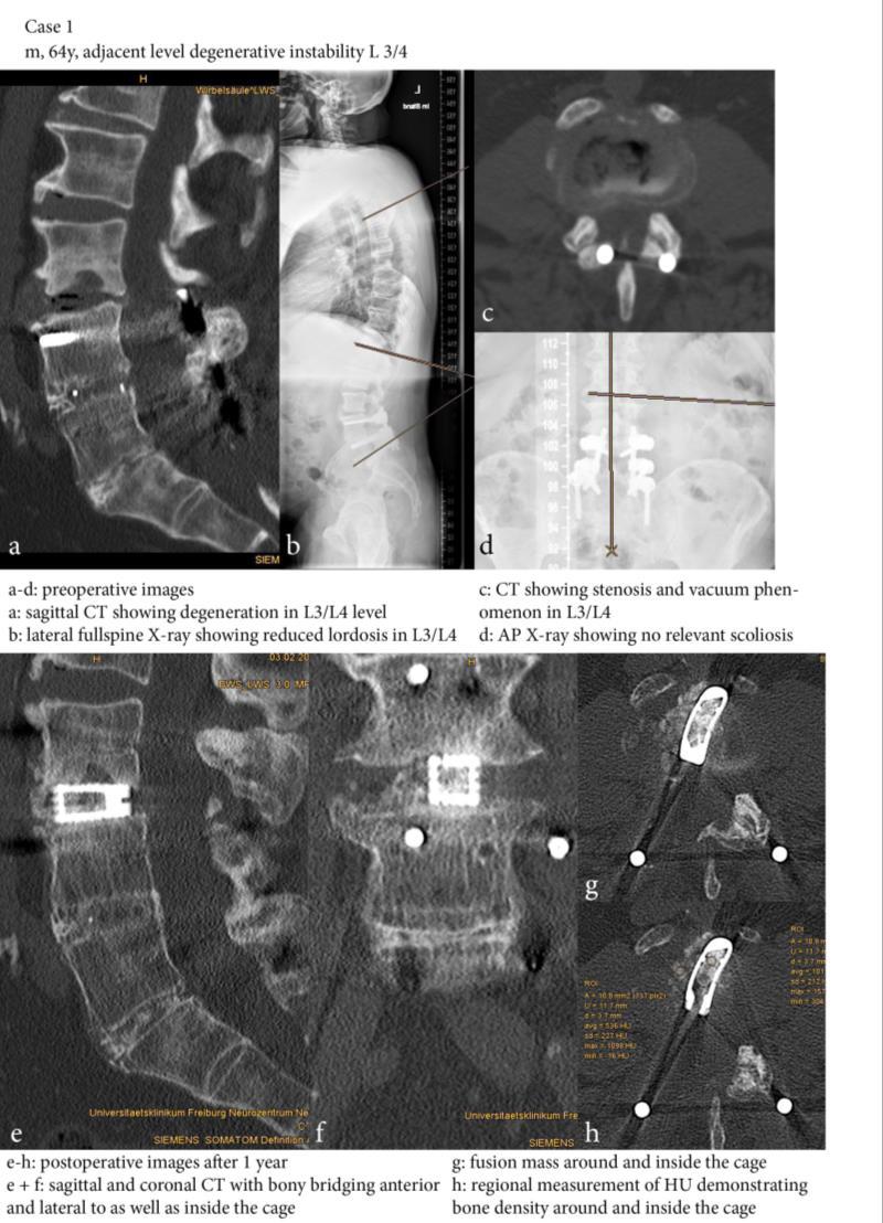 With patient in prone position the spondylodesis was prolonged to L 3 decompression of the spinal canal, distraction of the intervertebral disc space and interposition of a 12 lordotic shaped