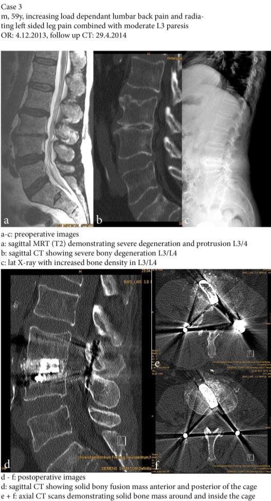 CASE REPORT 3 left side and a spondylolisthesis (Meyerding Grade I). Functional X-rays showed mobility of the spondylolisthesis. Full spine X-ray showed no signs of severe sagital imbalance.
