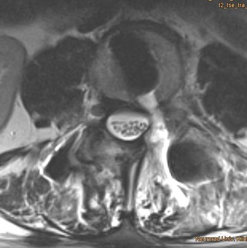 Preoperative sagital MRI showing the narrowed spinal canal L3 / 4 and the synovial cyst.