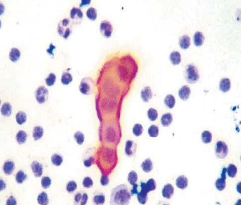 Figure 3 HBME 1 positive reactive mesothelial cells and a group of malignant negative