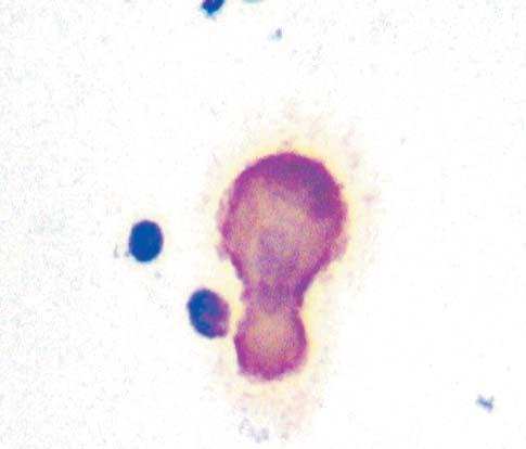 Figure 5 HBME 1 positive malignant mesothelial cells with thick membrane pattern,