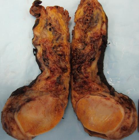 Spontaneous regression of gonadal GCT [so-called burnt-out germ cell tumor] No identifiable invasive neoplasm Dense, hyaline scarring,