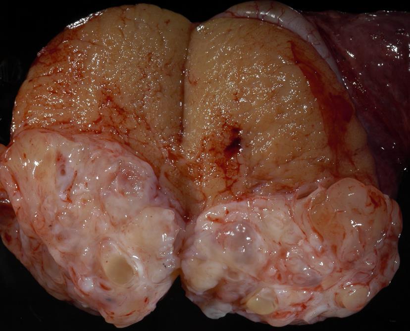 Teratoma: Post-Pubertal Type Most are mixed with other GCT elements; 4% are pure Capable of metastasis despite lack of malignant appearance May