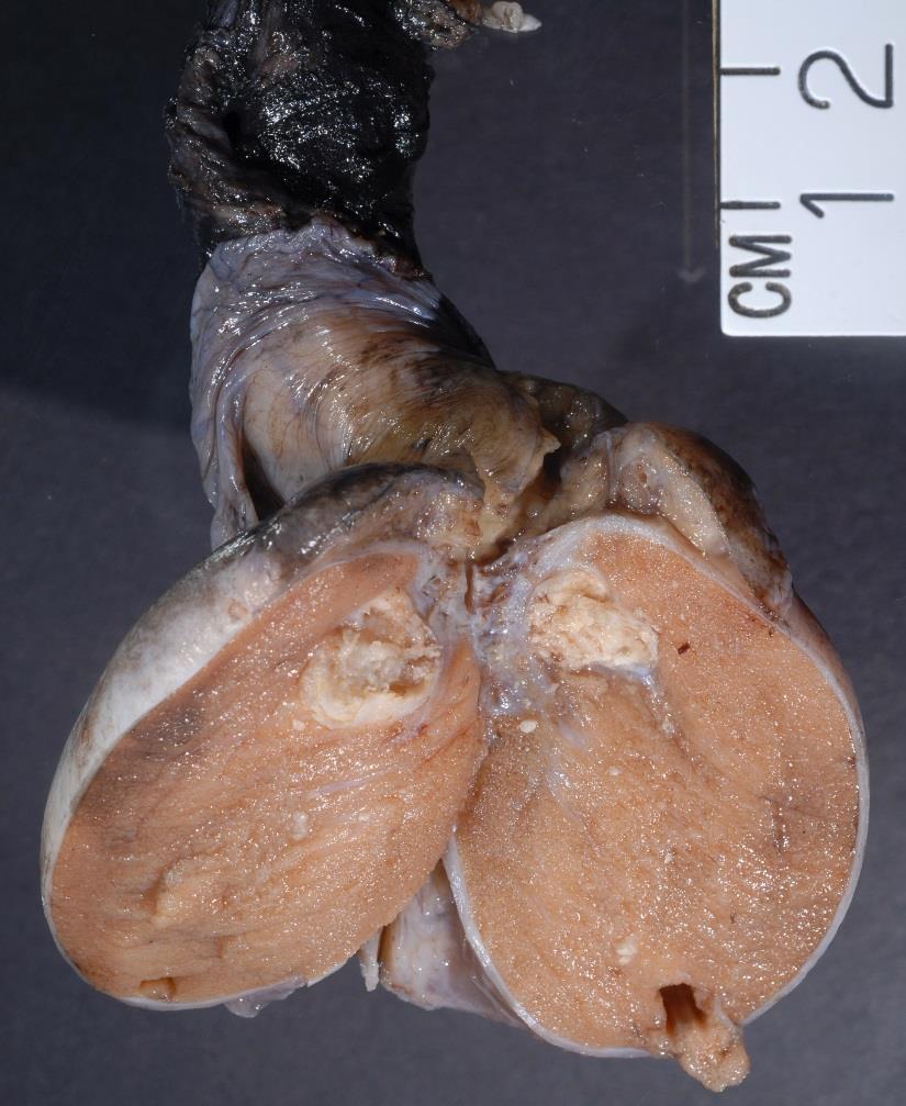 Teratoma: Prepubertal Type GCT usually seen in pre-pubertal testis Composed of elements resembling somatic tissues derived from one of