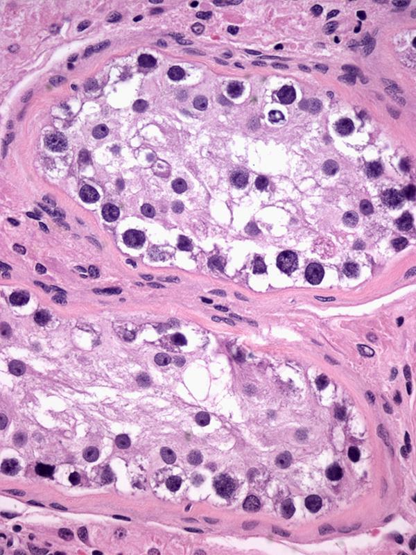 Germ Cell Neoplasia
