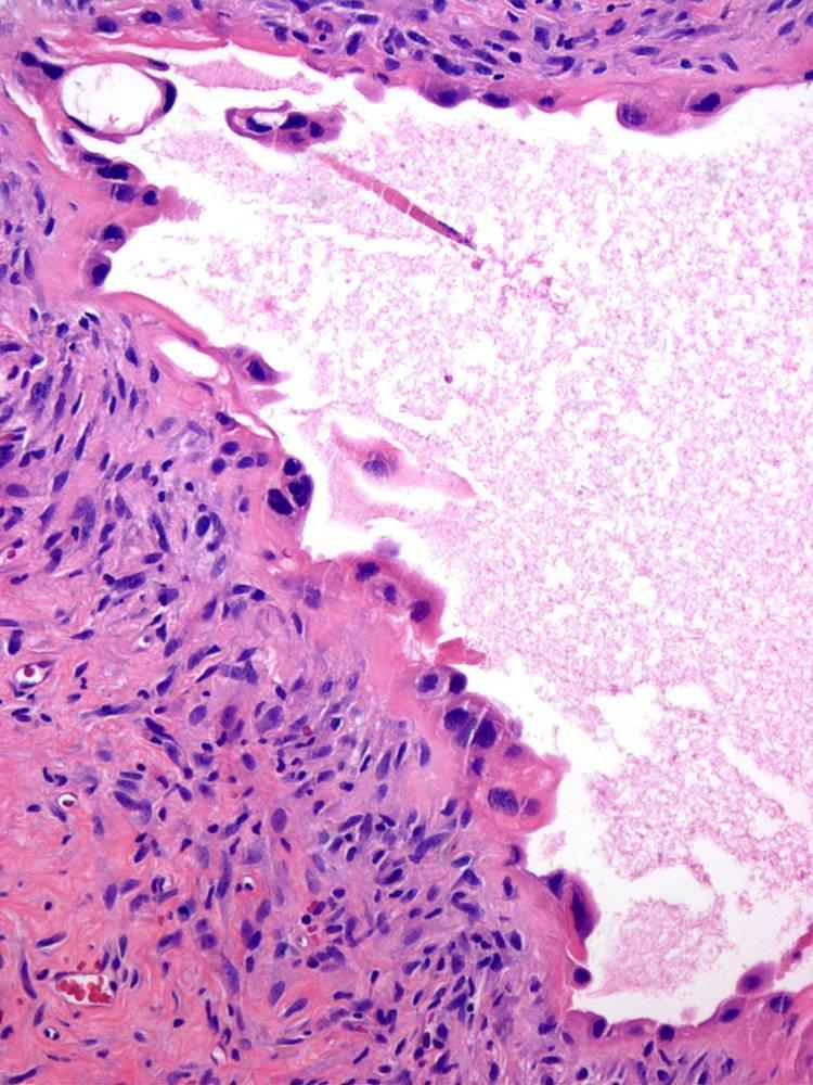 Non-choriocarcinomatous trophoblastic tumors: Cystic Trophoblastic Tumors May evolve from choriocarcinoma with regression of highly proliferative elements Occur mostly in metastatic sites after