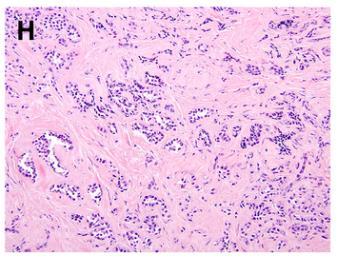 Changes in Sex Cord-Stromal Tumor Sclerosing Sertoli cell tumor -