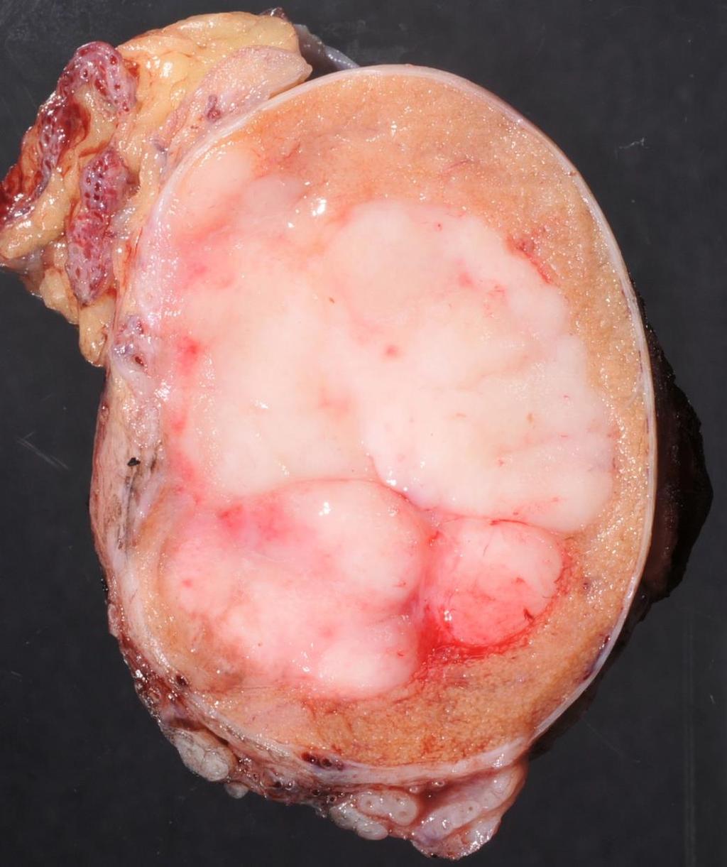 8th AJCC/TNM Staging of Testicular Tumors In seminoma, T1 is subclassified to T1a and T1b