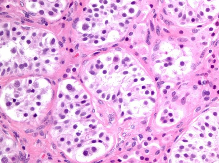 Differential Diagnosis of GCNIS Delayed maturation of gonocytes in prepubertal patients with sex development disorder (beyond 6 mo) - OCT3/4+, PLAP+; central tubular location Atypical germ cells due