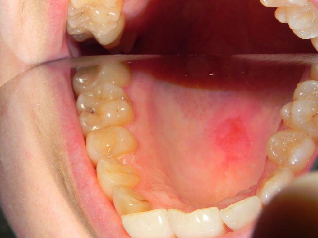 Systemic Lupus Erythematosus Lupus Oral