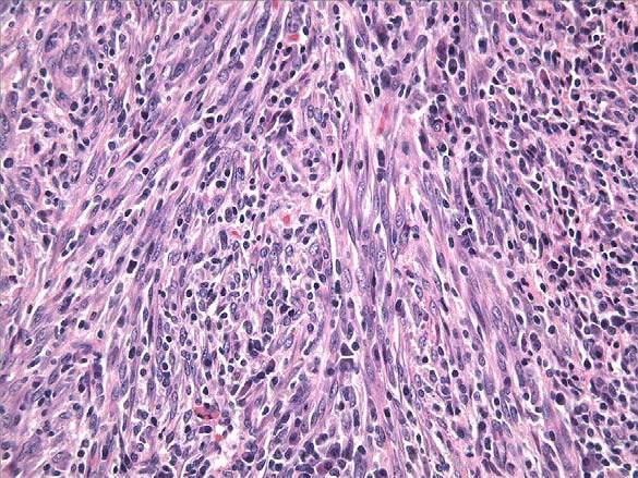 Inflammatory Myofibroblastic Tumor: Histologic Features Fascicles of