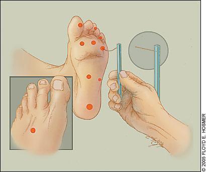 Screening for the high risk diabetic foot: A 60-Second Tool (2012) Sibbald General Instructions: This diabetic foot screening tool is designed to identify individuals with high-risk diabetic feet.