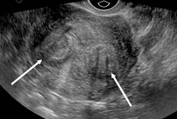 Placental abnormalities Fetal growth Postpartum hemorrhage Evaluation Ultrasound