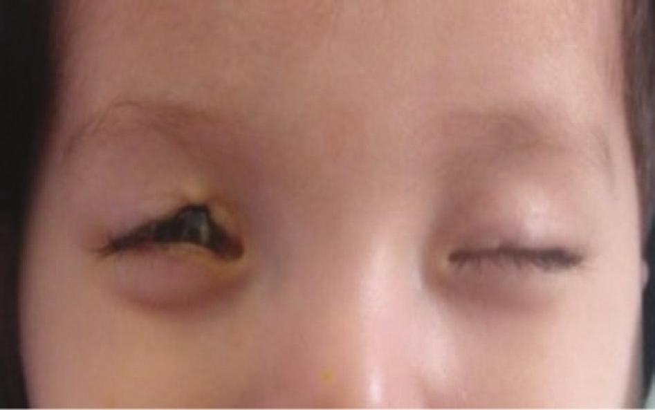 Case Reports in Ophthalmological Medicine 3 (a) Figure 2: (a) Case 4 with 5 months old. The patient has bilateral eyelid coloboma. (b) Case 4. At the age of 2 years after surgery.