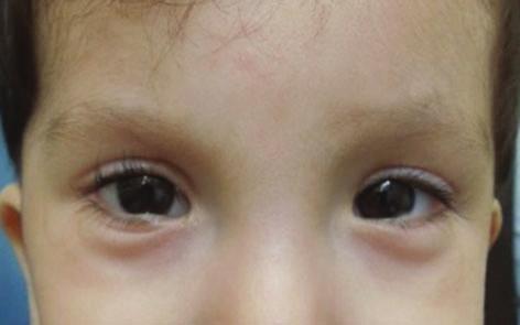 The eyelid defect was repaired with a Mustarde rotational flap which was opened 4 weeks later.