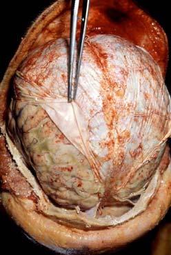 An autopsy demonstrating signs of pneumococcal meningitis. The forceps are retracting the dura mater.