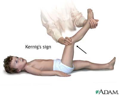 Brudzinski s Sign: Maneuver: Place patient in the supine position and passively flex the head towards