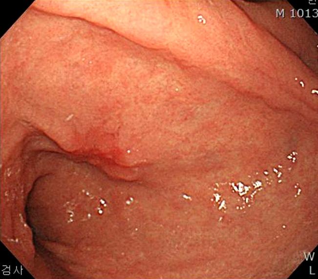 LADG with situs inversus totalis CASE REPORT A 60-year-old man visited our clinic for operation of gastric cancer incidentally