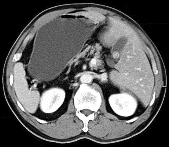 midantrum. Tissue biopsy showed well-differentiated tubular adenocarcinoma. Fig. 4.
