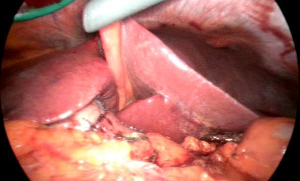 Right gastroepiploic artery located on the left side was divided with double clips, allowing a