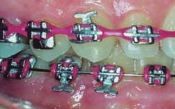to the arch wire, offers a low-friction option to enhance early dental alignment Figure 6: Traditional Begg vertical slot auxiliaries, 6 such as uprighting and rotating springs, can be used to