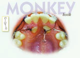 Figure 9A-9D: The Monkey Hook 9,11 auxiliary is designed to assist with impacted, rotated, and displaced teeth. It may also be used to attach elastic chain or coil springs to mini-screws.