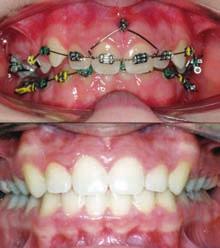 orthodontic brackets in wearing elastics.