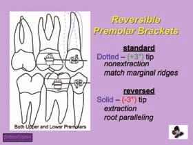 brackets 30 Figure 29: Reversible second premolar