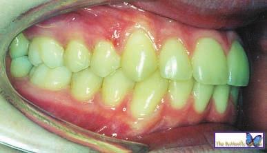 30: Angulated second premolar brackets improve marginal