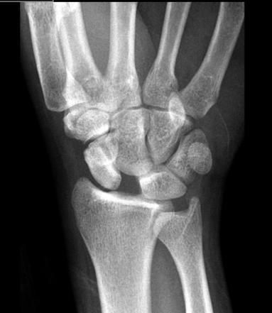 Hand and Wrist Scaphoid fracture