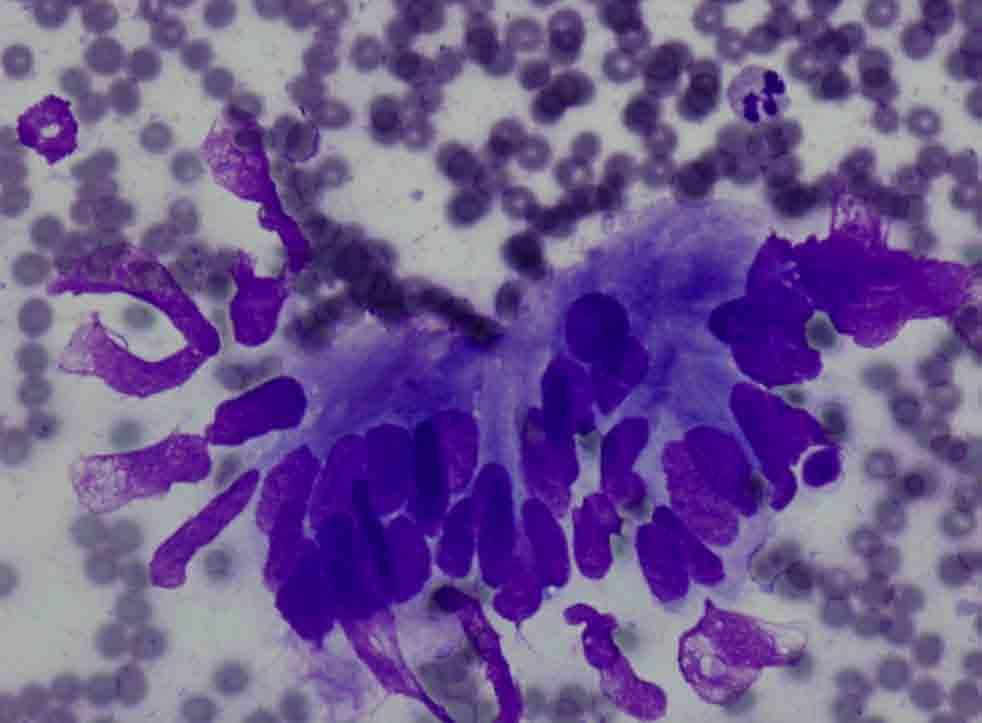 Lung, RUL, CT-guided FNA: Diff-Quik stain Presentation material is for