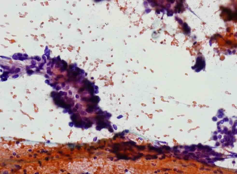 Lung, RUL, CT-guided FNA: Papanicolaou stain Presentation material is for