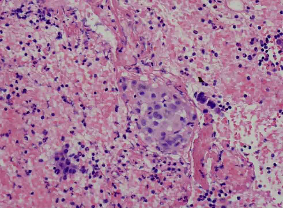 Lung, RUL, CT-guided FNA: Cell Block, hematoxylin & eosin stain Presentation material