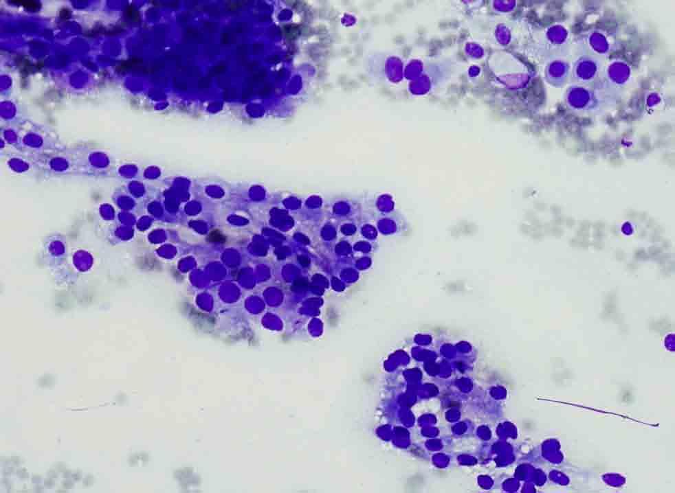 Lung, RUL, CT-guided FNA: Diff-Quik stain Case 2 Presentation material is for