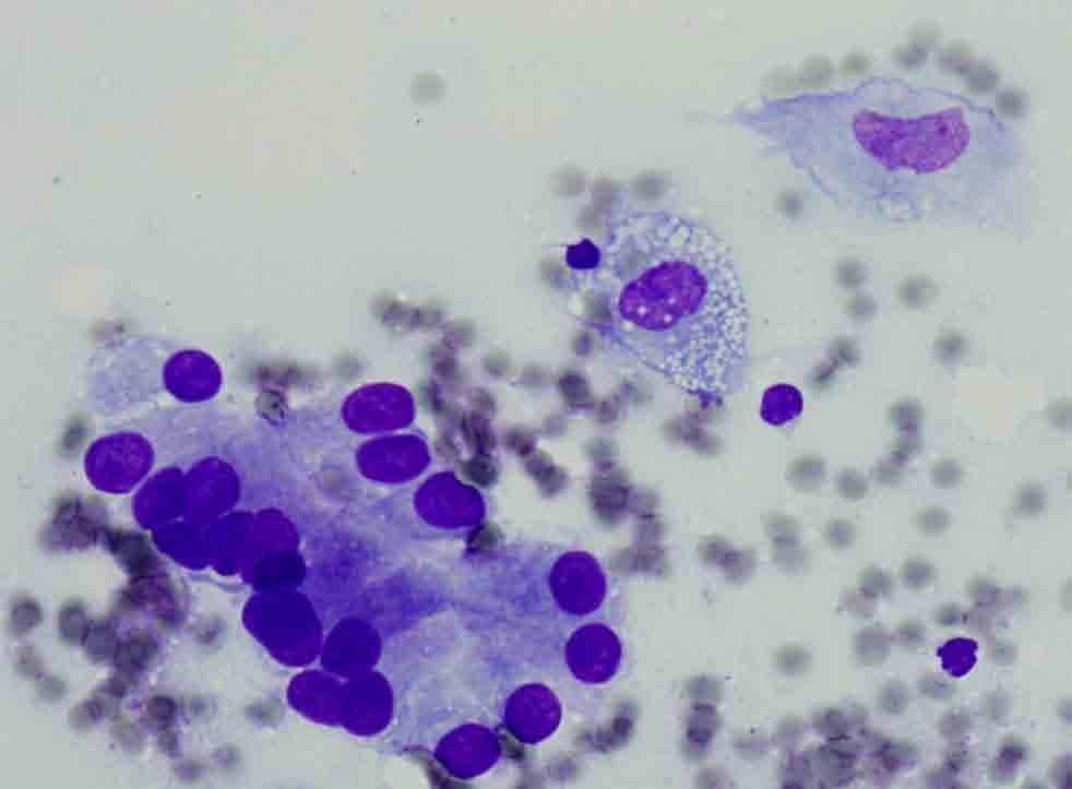 Lung, RUL, CT-guided FNA: Diff-Quik stain Presentation material is for